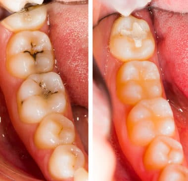 Composite Fillings in Buffalo, NY Cavity Filling Dentist Dr. Todd Shatkin