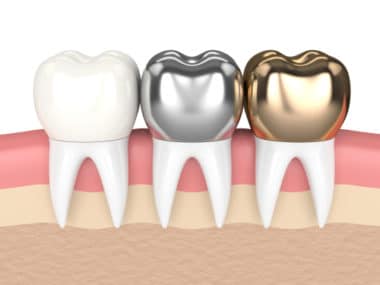 Dental Crowns in Buffalo, NY | Todd Shatkin DDS | Buffalo Dentist