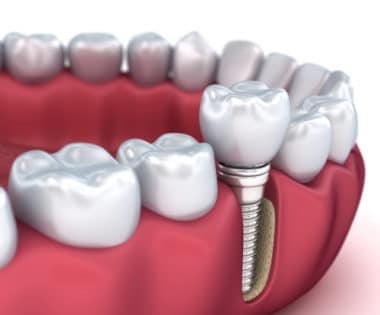 Dental Implants in Buffalo, NY Todd Shatkin DDS Dental Implant Dentist