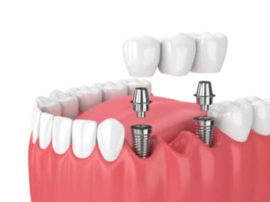 Fixed Dental Bridges Dental Implants Buffalo Dentist Todd Shatkin DDS