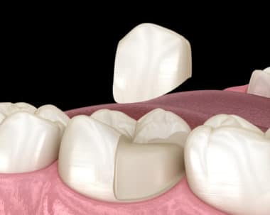 Porcelain Onlays in Buffalo, NY Todd Shatkin DDS Cosmetic Dentist