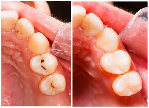 5 Signs You Need a Tooth Filling | Todd Shatkin DDS | Buffalo Dentist