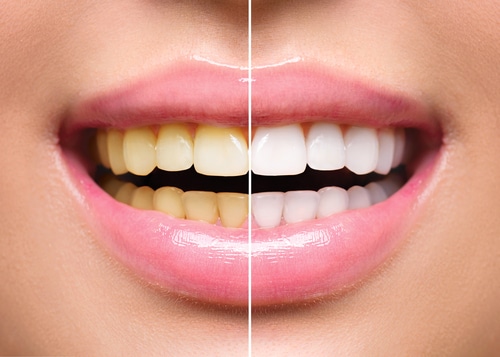 5 Things You Need to Know about Teeth Whitening | Todd Shatkin DDS