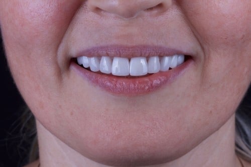 Dental Veneers | Todd Shatkin DDS | Cosmetic Dentist | Buffalo Dentist