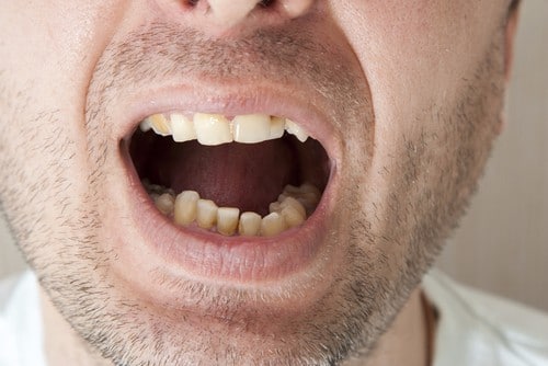 Dental Bonding | Buffalo Dentist | Todd Shatkin DDS | Free Consultation