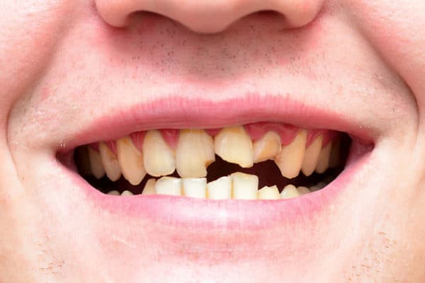 Fixing Broken Teeth | Todd Shatkin DDS | Buffalo Dentist