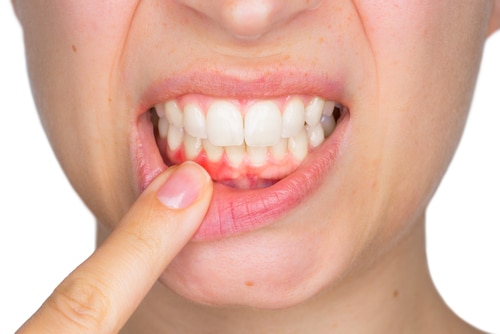 Gum Disease Treatment | Todd Shatkin DDS | Buffalo Dentist