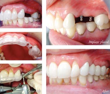 Mini-Dental Implants Todd Shatkin DDS Implant Dentist in Buffalo, NY 2