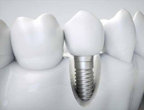 Affordable Dental Implants | Todd Shatkin DDS | Buffalo Dentist