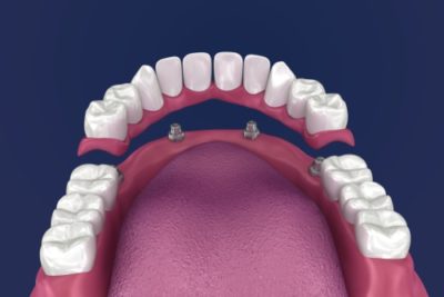 Affordable Dentures in Buffalo, NY Mini Dental Implants Dr. Todd Shatkin