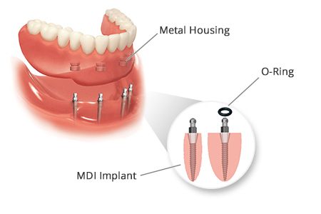 Affordable Dentures in Buffalo, NY Mini Dental Implants Dr. Todd Shatkin