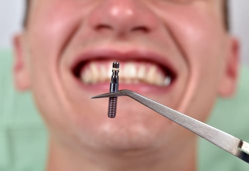 Mini Dental Implants Cost Buffalo Implant Dentist Todd Shatkin DDS