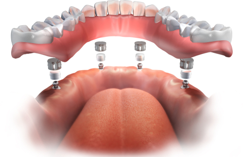 Mini Dental Implant Treatment in Buffalo, NY | Dr. Todd Shatkin DDS