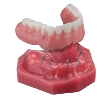 Snap On Dentures in Buffalo Implant Retained Dentures