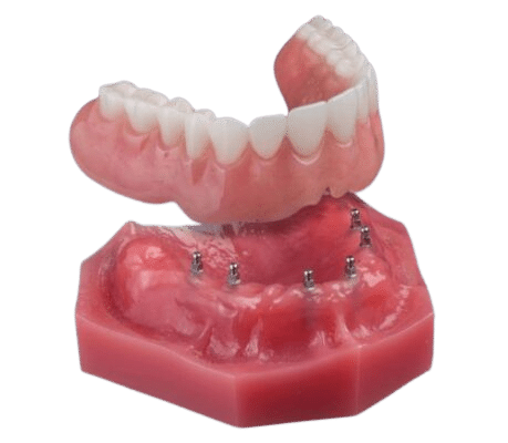 Snap On Dentures in Buffalo Implant Retained Dentures