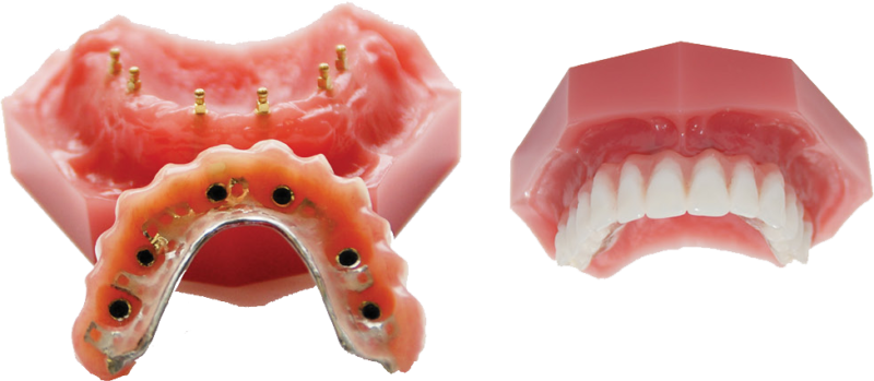 Snap-In Dentures Implant Retained Dentures Dr. Todd Shatkin DDS