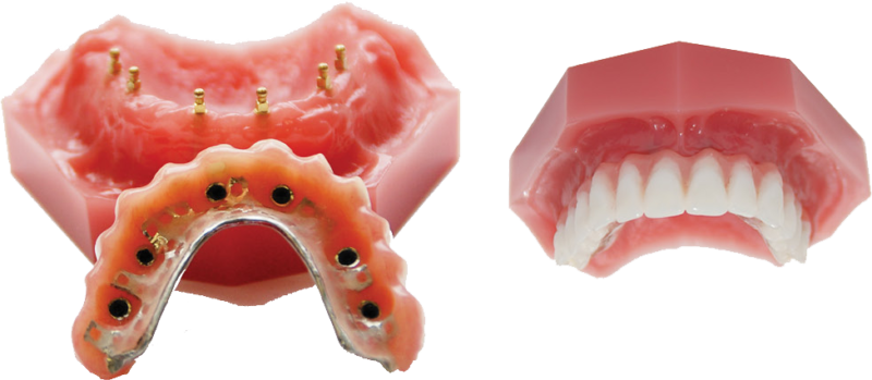 Snap-In Dentures Implant Retained Dentures Dr. Todd Shatkin DDS