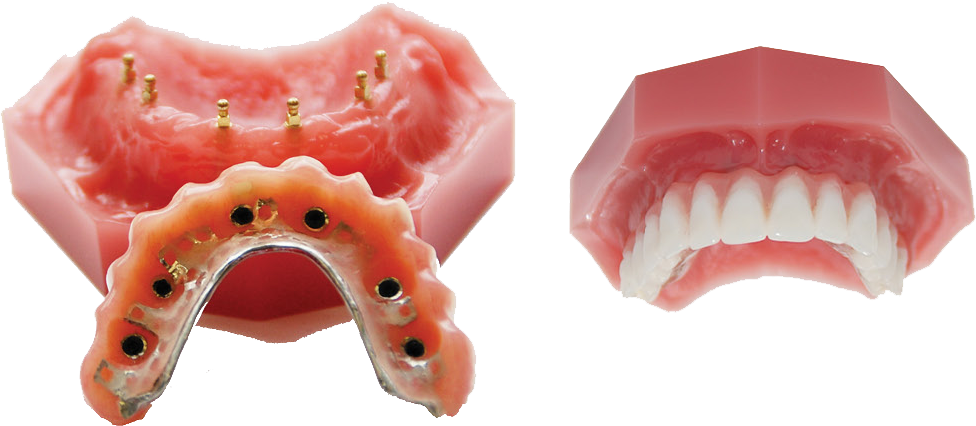 Snap-In Dentures Implant Retained Dentures Dr. Todd Shatkin DDS