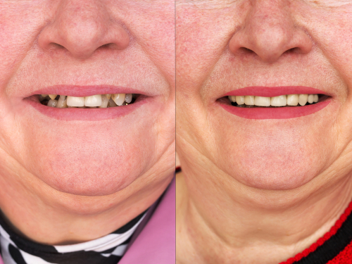 Are Mini Dentures Right for Me?