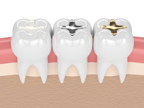 Composite Filling for a Cavity