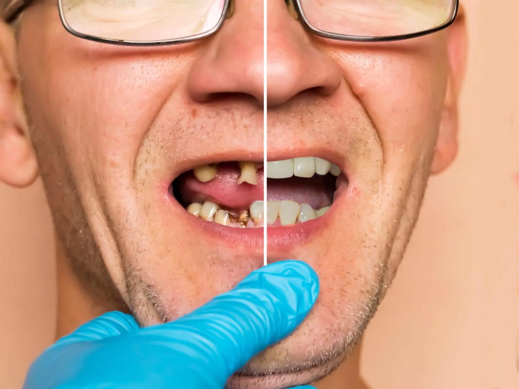 Losing Teeth How We Can Help Buffalo Dentist Free Consultation