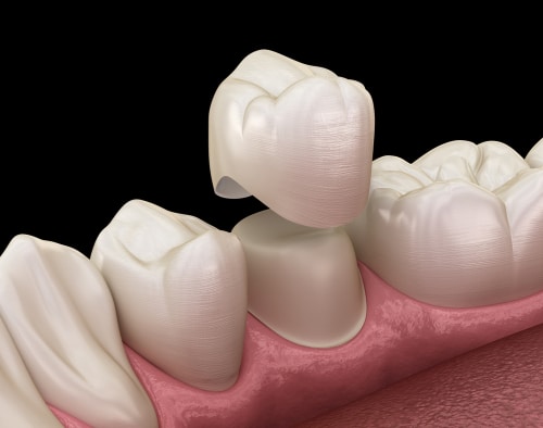 Broken Teeth Causes and Treatments Buffalo Dentist Free Consultation