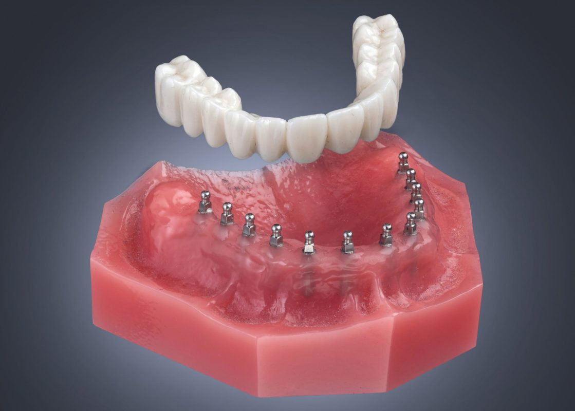 Snap-in Denture for Tooth Loss Buffalo Dentist Free Consultations