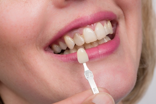 Benefits of Permanent Teeth Whitening | Buffalo Dentist | Free Consultation