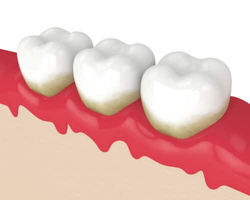 Gum Irritation Causes and Treatments Buffalo Dentist Free Consultation
