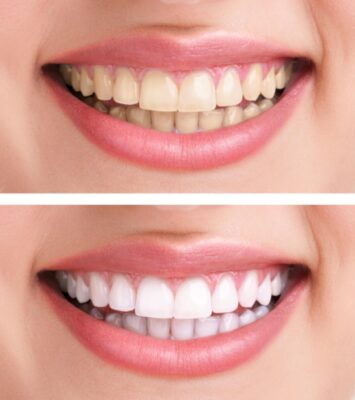 Teeth Whitening Treatment Options Buffalo Dentist Free Consultation