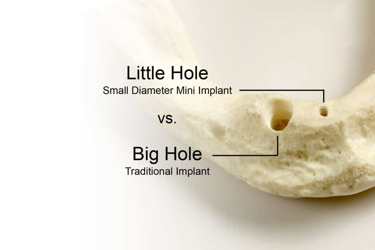 Benefits of Mini Implants vs Traditional Implants Buffalo Cosmetic Dentist