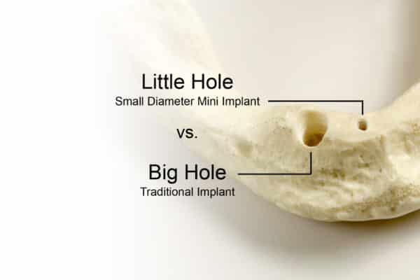 Benefits of Mini Implants vs Traditional Implants Buffalo Cosmetic Dentist