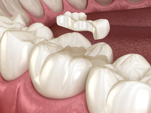 Porcelain Onlay Treatment in Buffalo Buffalo Dentist Free Consultation