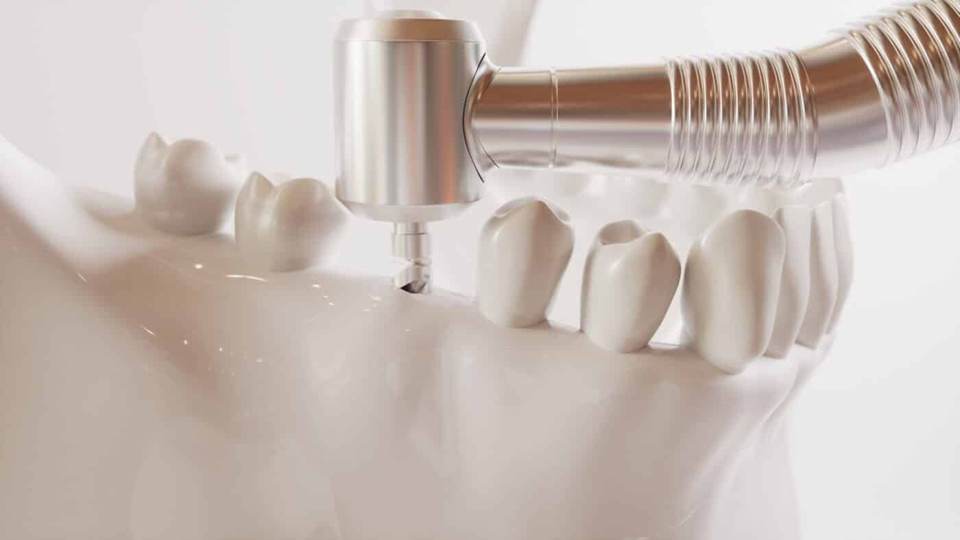 Tooth Replacement Options Buffalo Dentist Free Consultations Available