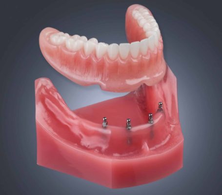 Shatkin Mini Dental Implants | Dr. Todd E. Shatkin | Aesthetic Associates