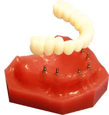 Fix on Six Dental Implants in Buffalo Free Consultation Dr. Todd Shatkin