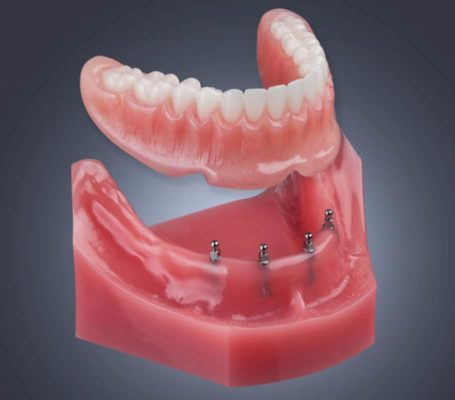 Immediate Dentures in Buffalo, NY Same-Day Implant-Retained Denture