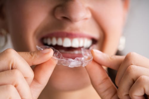 Clear Aligners in Buffalo, NY | Krystal Klear | Free Consultations