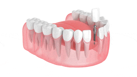 Dental Implants in Buffalo, NY | Mini Implants | Free Consultations