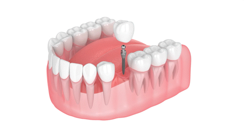 Same-Day Dental Implants in Buffalo, NY | Mini Dental Implants