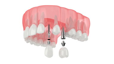Mini Implant Dentistry in Buffalo, NY | Mini Implants | New Teeth