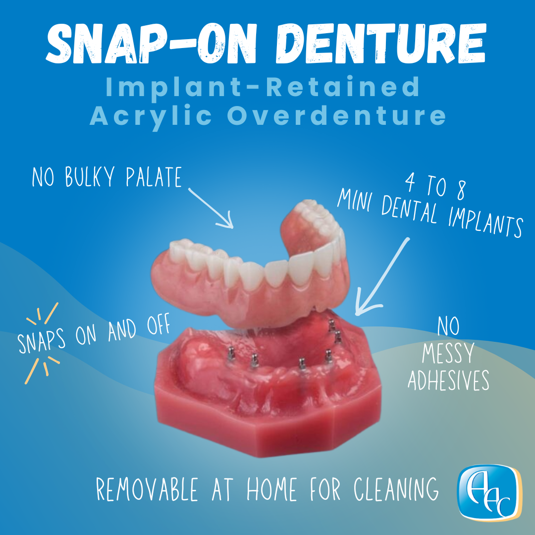 Snap-On Denture in Buffalo, NY