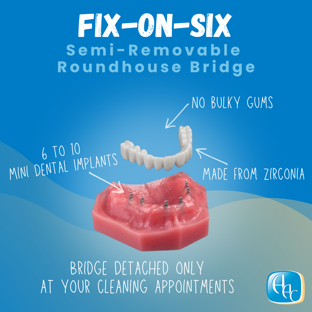 Fix-on-Six Implant Denture in Buffalo, NY