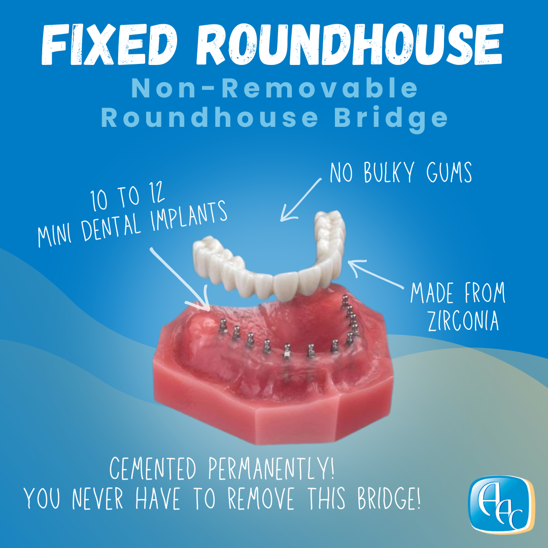Fixed Roundhouse Bridge Implant Denture in Buffalo, NY