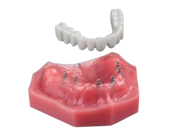 All-on-4 Alternatives in Buffalo, NY | Fix-on-Six | Mini Dental Implant