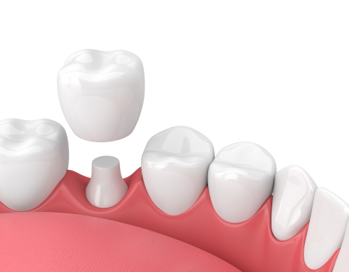 Dental-Crown-in-Buffalo-NY-Dr.-Todd-Shatkin