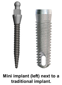 Implant Dentures in Buffalo, NY | Mini Implants | Free Consultations