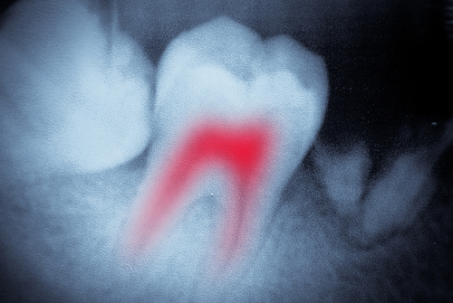 Root Canal Treatment in Buffalo, NY - Dr. Todd Shatkin