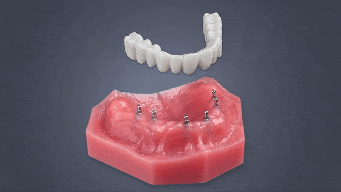 Roundhouse Bridge in Buffalo, NY | Free Mini Implant Consultation