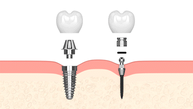 Buffalo Dental Implant Options | Free Mini Implant Consultations